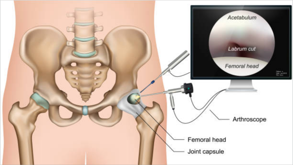 Arthroscopy